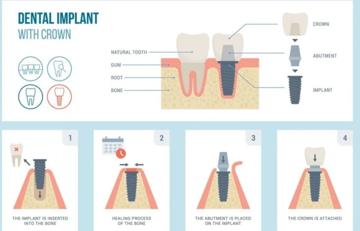 Clínica Dental de Fort Worth Ofrece Soluciones de Implantes Asequibles con Precios Transparentes