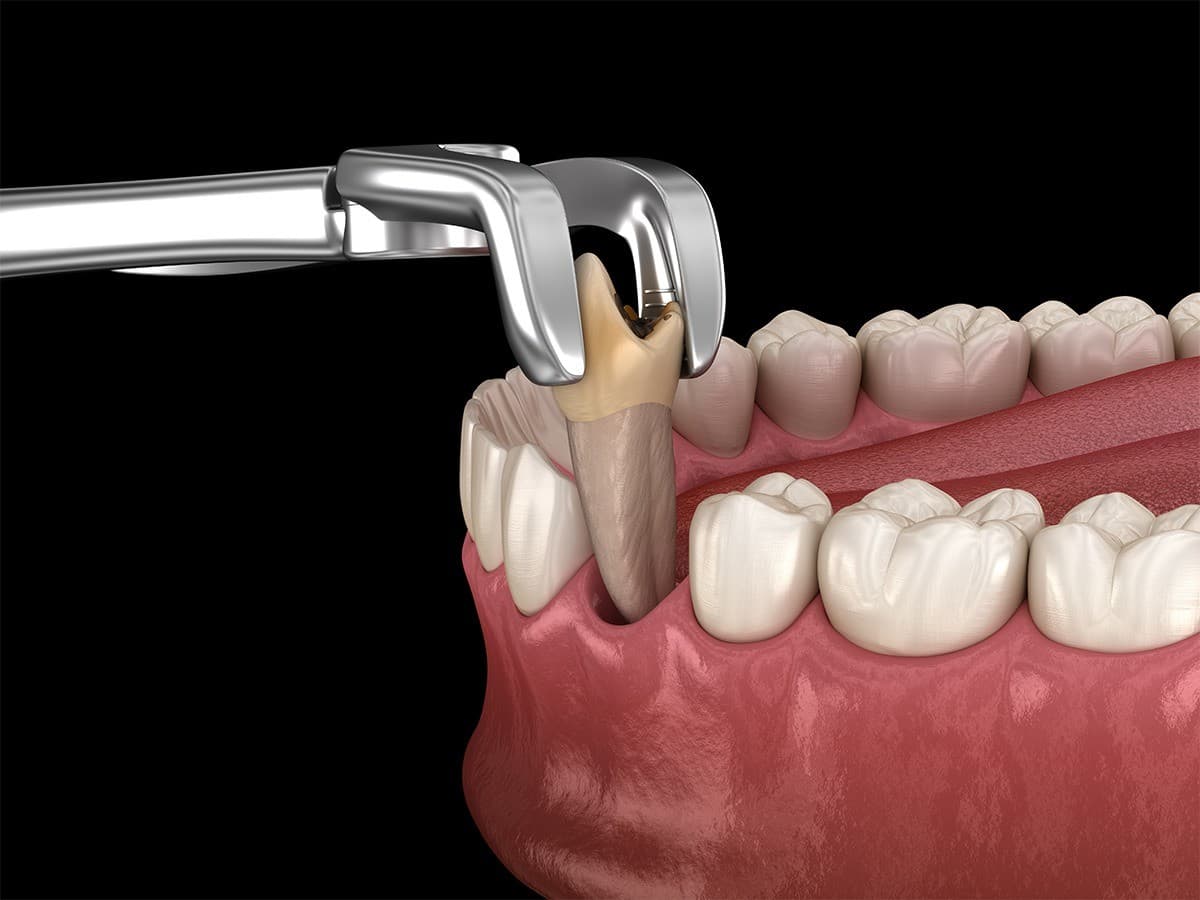Clínica de Cirugía Oral en Sioux Falls Publica Guía para Reducir la Ansiedad del Paciente ante las Extracciones Dentales