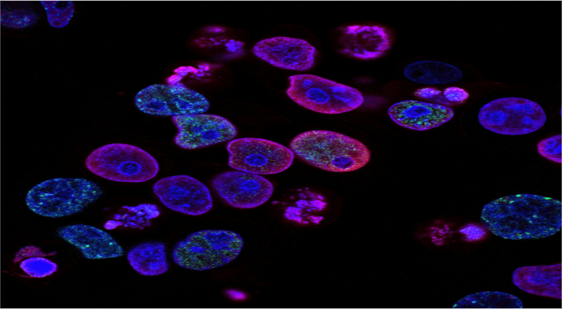 Surge un Avance Potencial en el Tratamiento del Cáncer de Próstata Metastásico