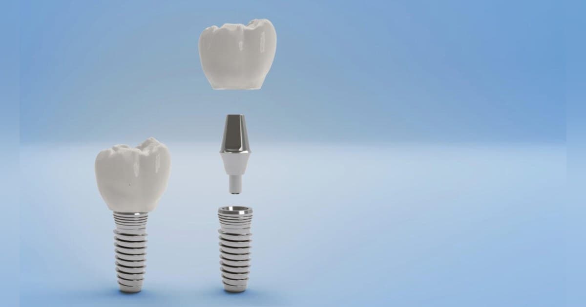 El Centro Dental Gunbarrel publica una guía clínica sobre opciones profesionales de blanqueamiento dental