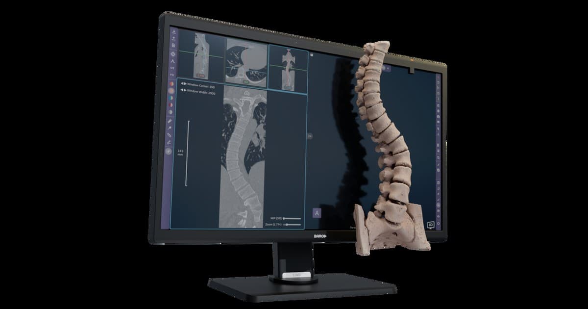 Avatar Medical Vision obtiene el marcado CE para planificación quirúrgica en 3D sin gafas
